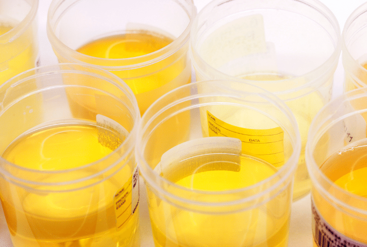 Urine Trouble: Causes of colored urine and their meaning
